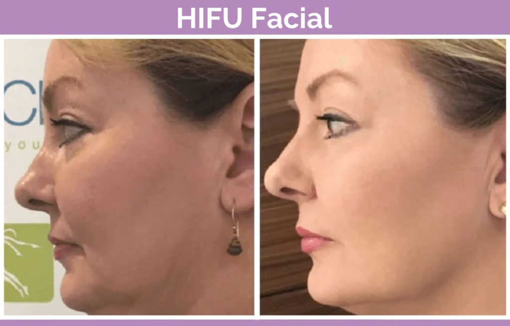 HIFU neck 1 1