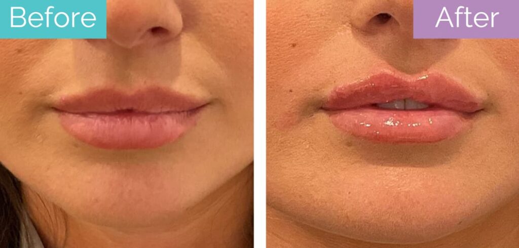 Lip filler before and after