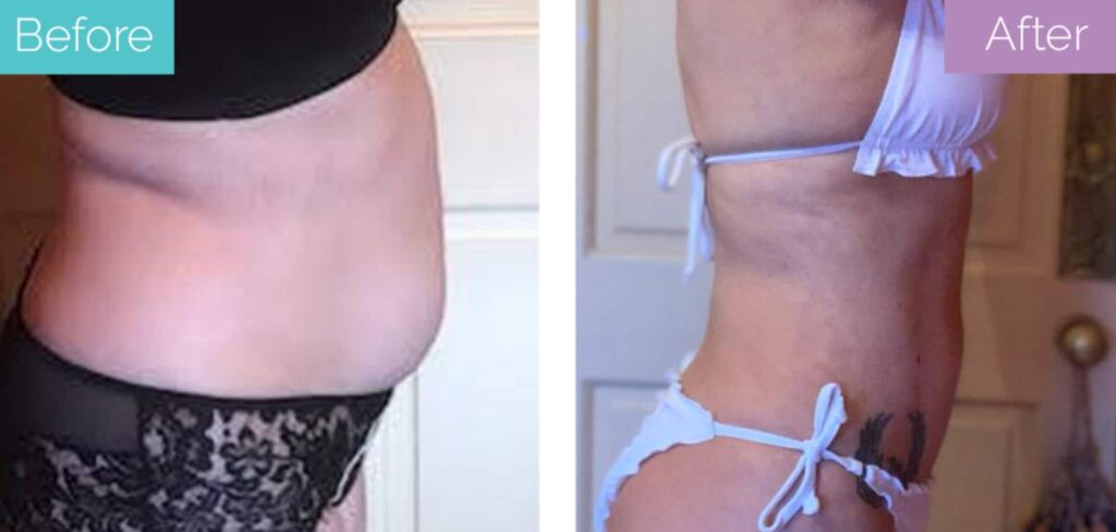 Love handles 360 lipo (1)