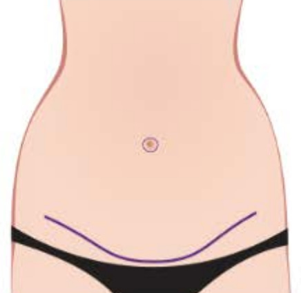 Mini tummy tuck incision