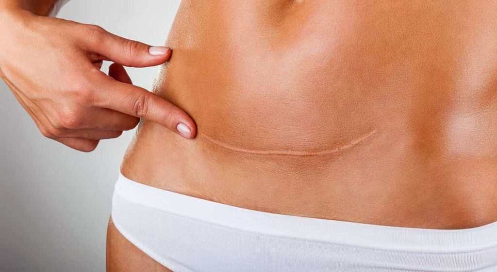 Mini tummy tuck scar