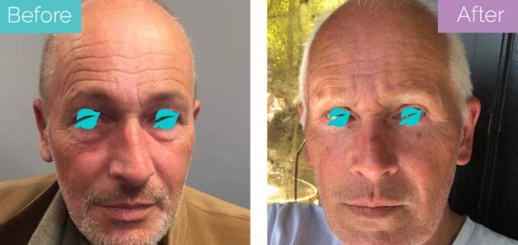 Rhinoplasty for crooked nose