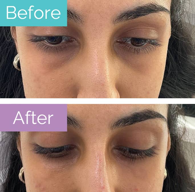Tear trough fillers