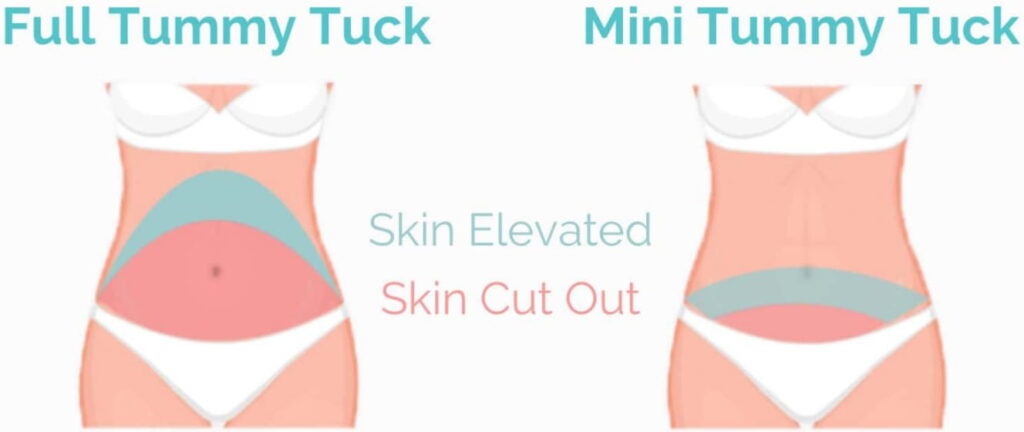 full vs mini tummy tuck
