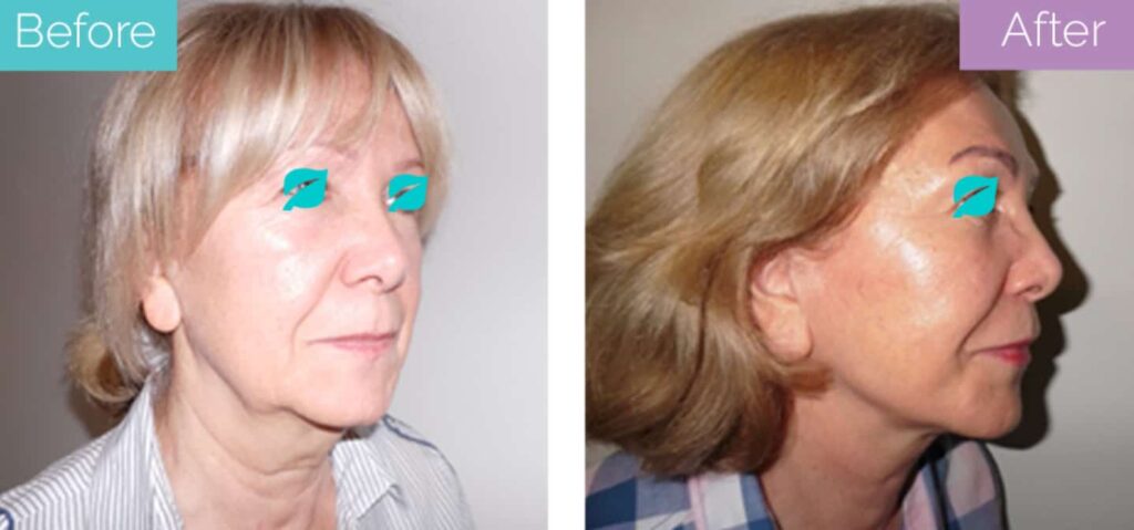 6 months post op neck lift