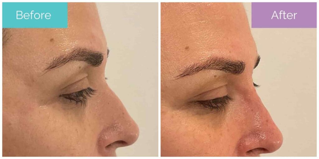 Dernal filler nose surgery