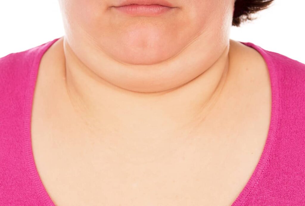 Double chin