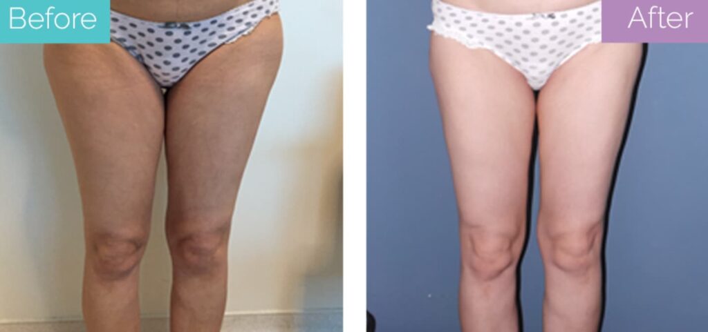 Liposuction before and after
