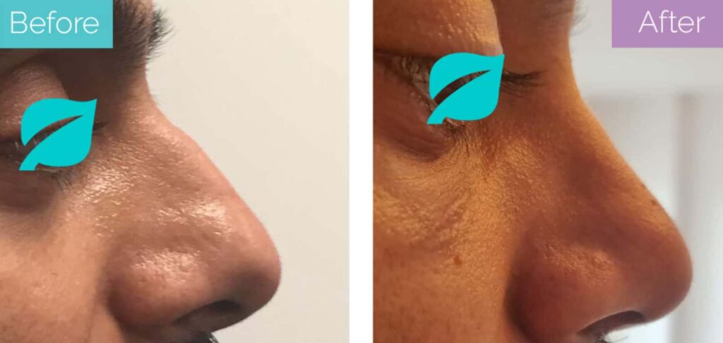 Male nose job dorsal hump
