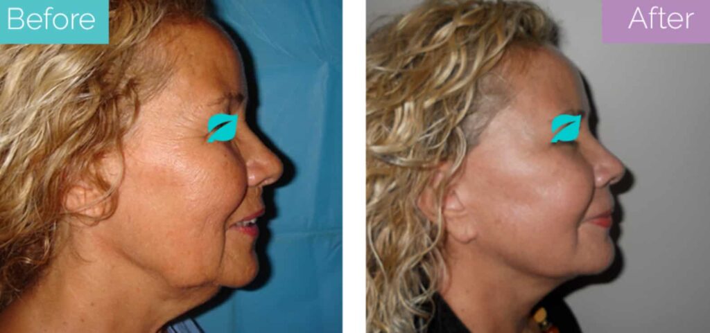 Neck lift before and after