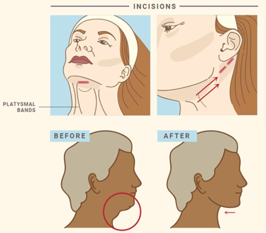 Neck lift incisions