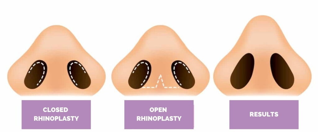 Nose job techniques