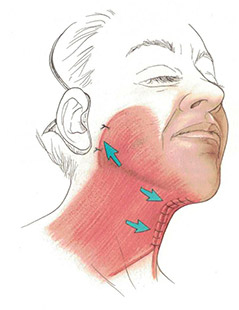 Platysmaplasty