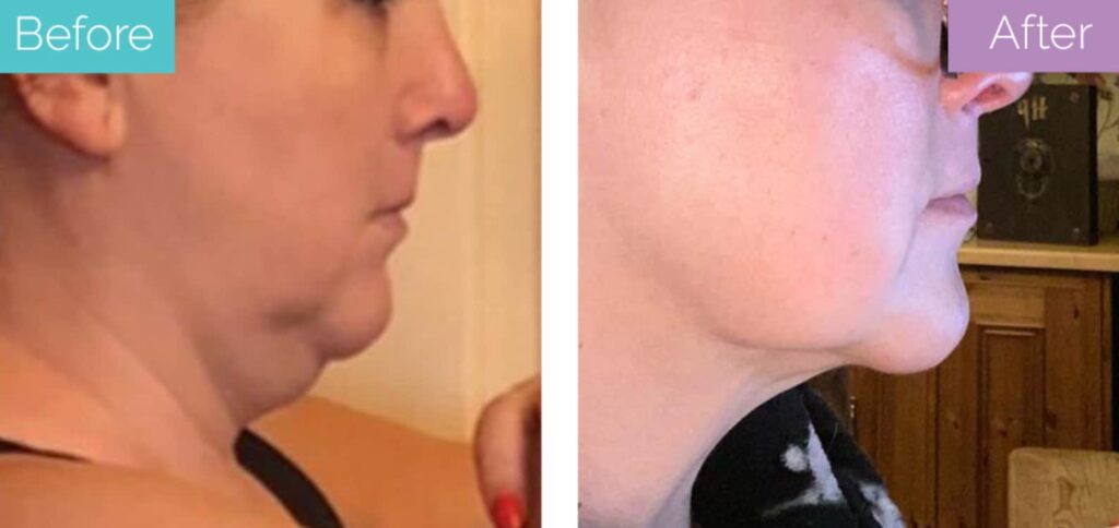 chin liposuction before and after