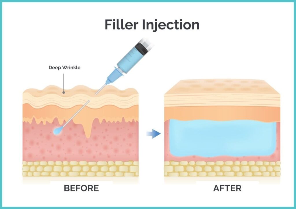 Dermal filler machanism