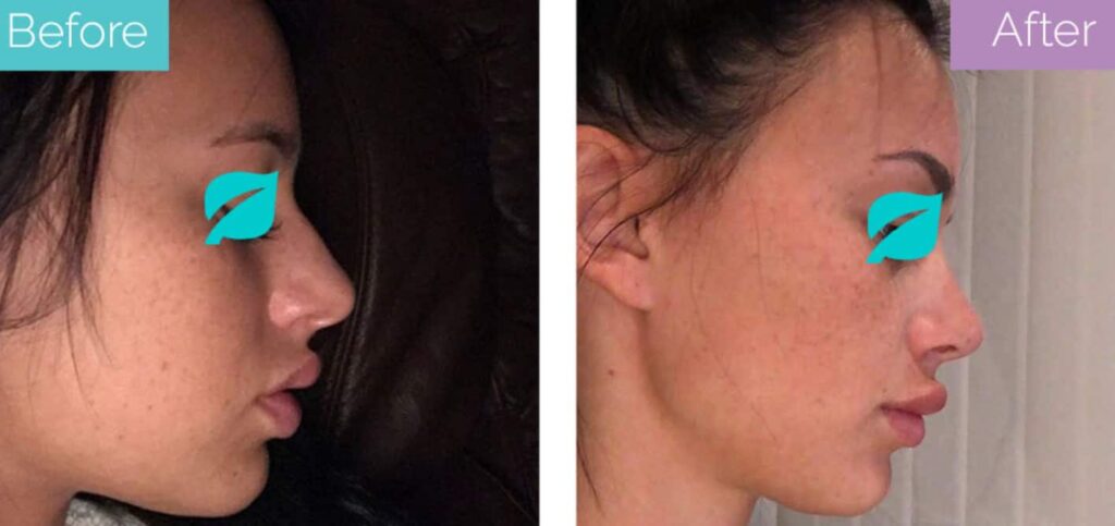 Nose job before and after