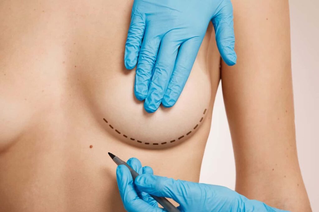 Inframammary incision