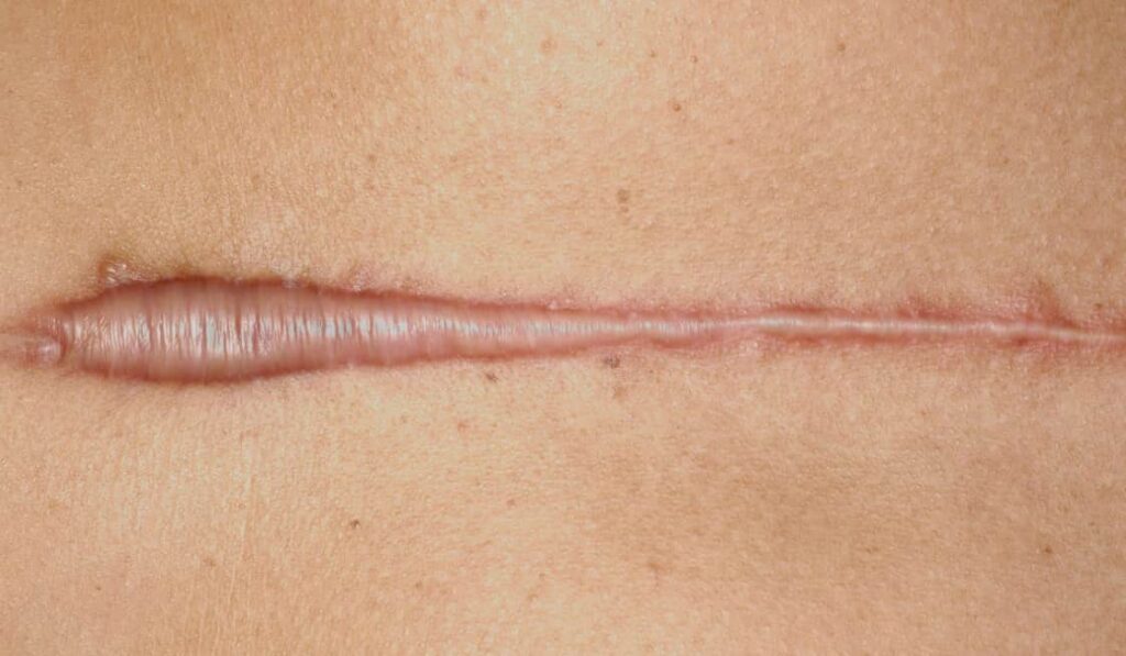 Thick scars