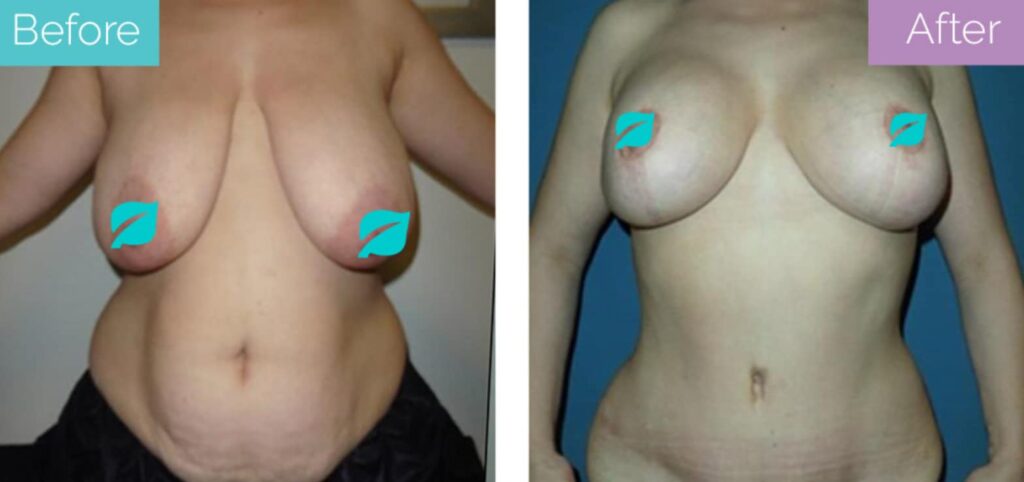 Traditional tummy tuck