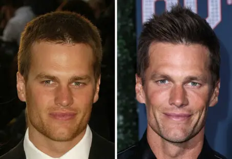 tom brady botox
