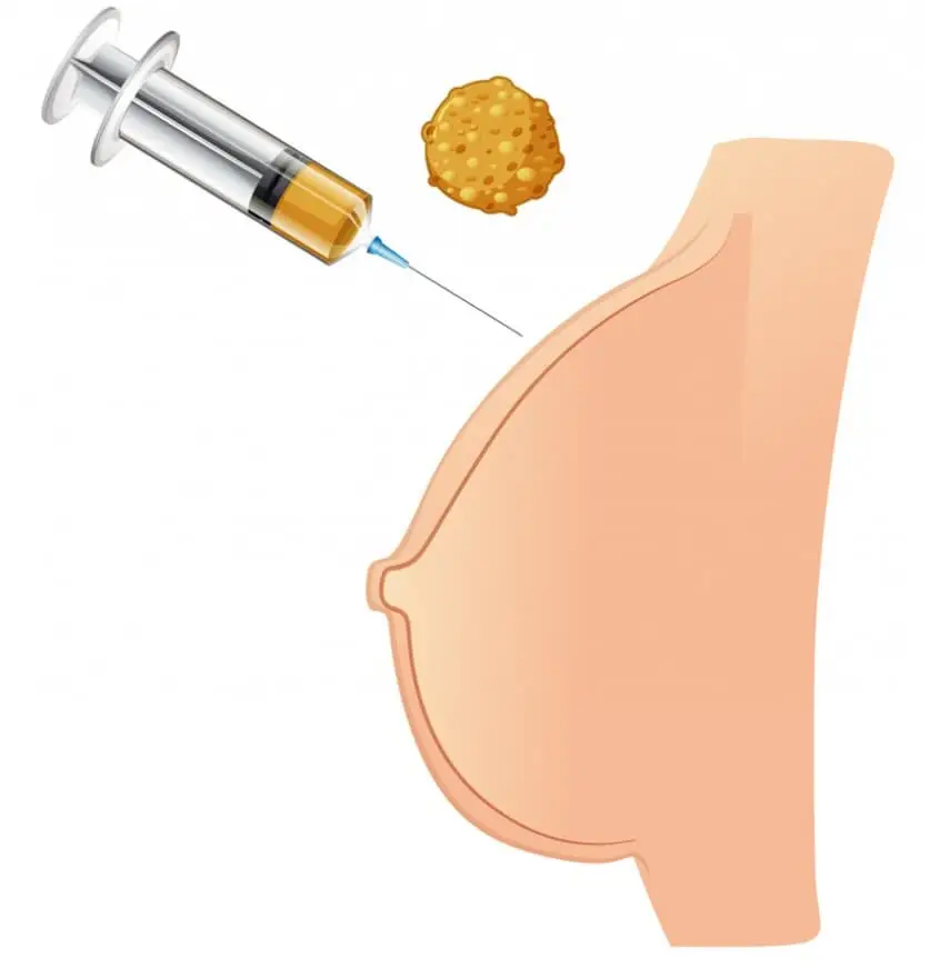 Fat transfer to breasts