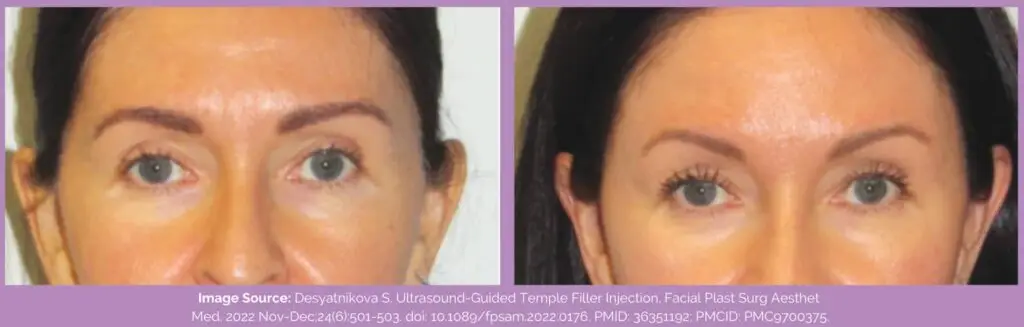 Temple filler before and after