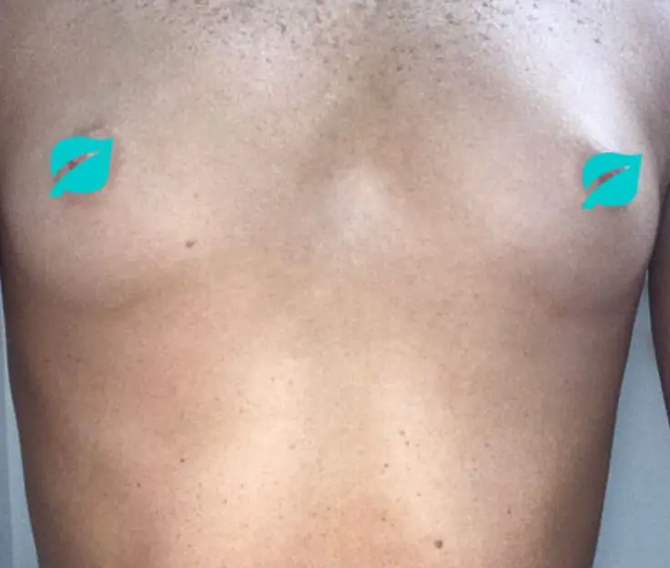 Wide set breasts