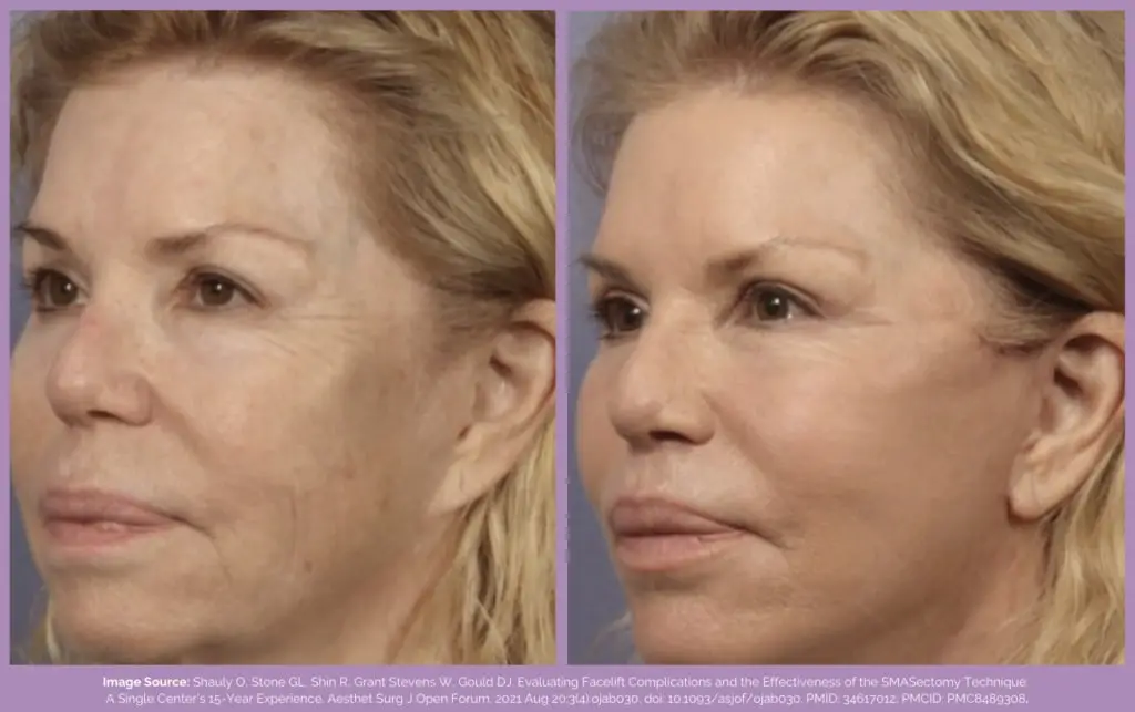 before and after smas facelift