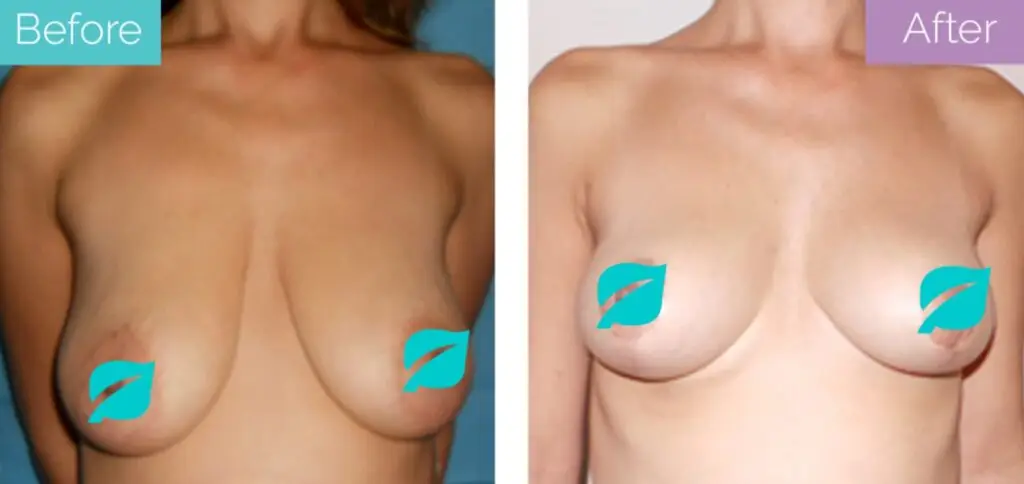 Breast lift