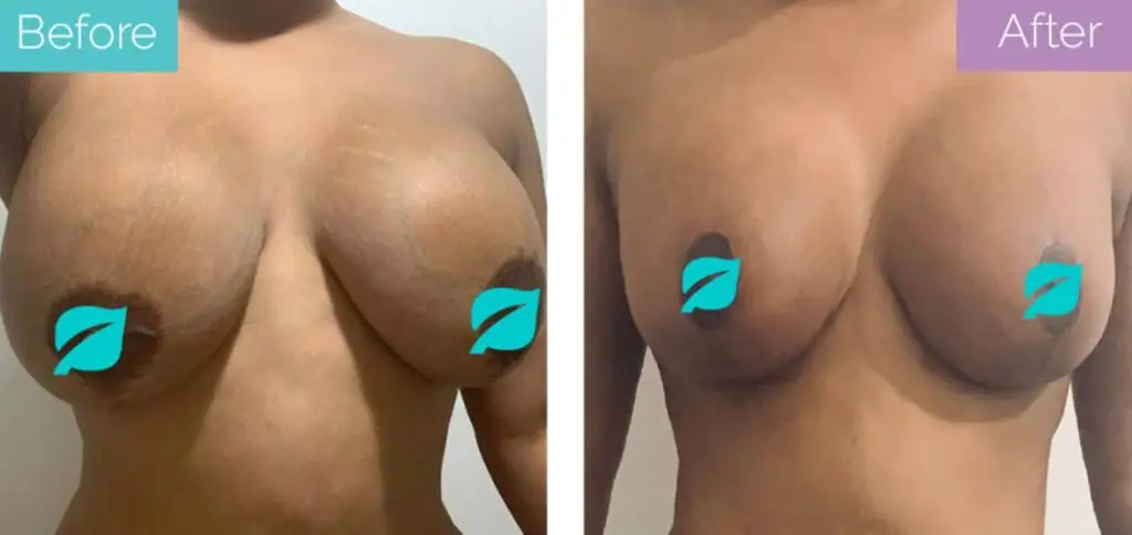 Breast reduction
