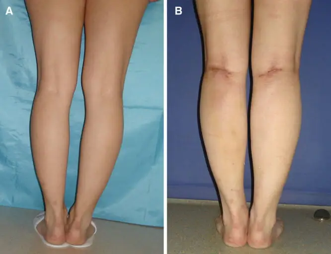 Calf implants before and after