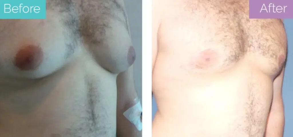 Gynecomastia surgery before and after