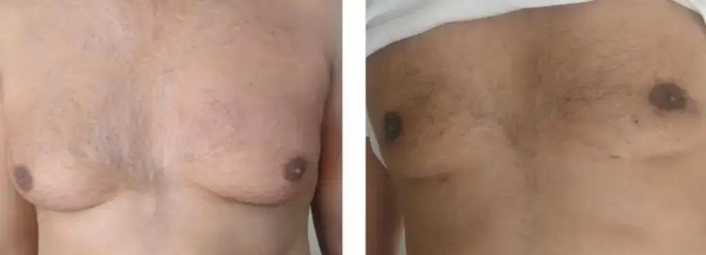 Gynecomastia surgery scars
