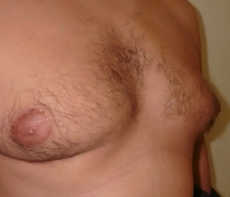 gynecomastia