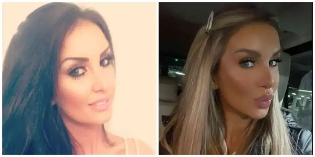 peggy mafs plastic surgery