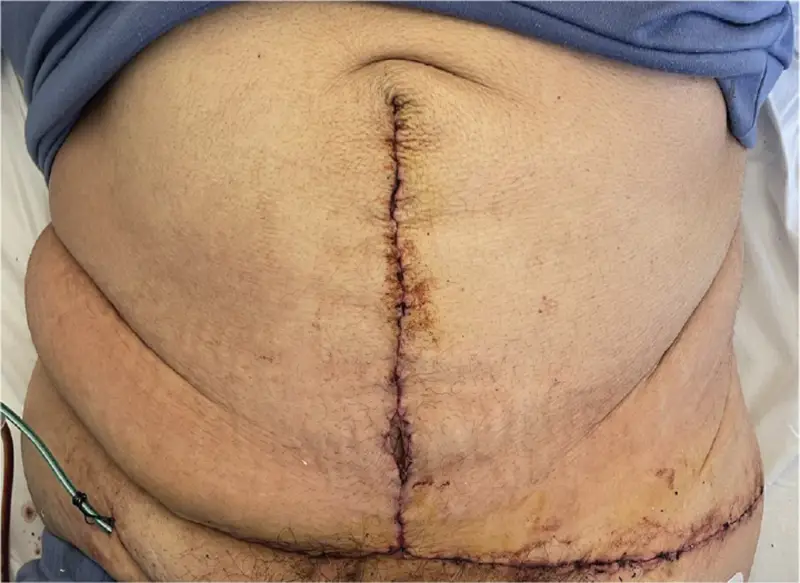 Fleur de lis tummy tuck incision lines