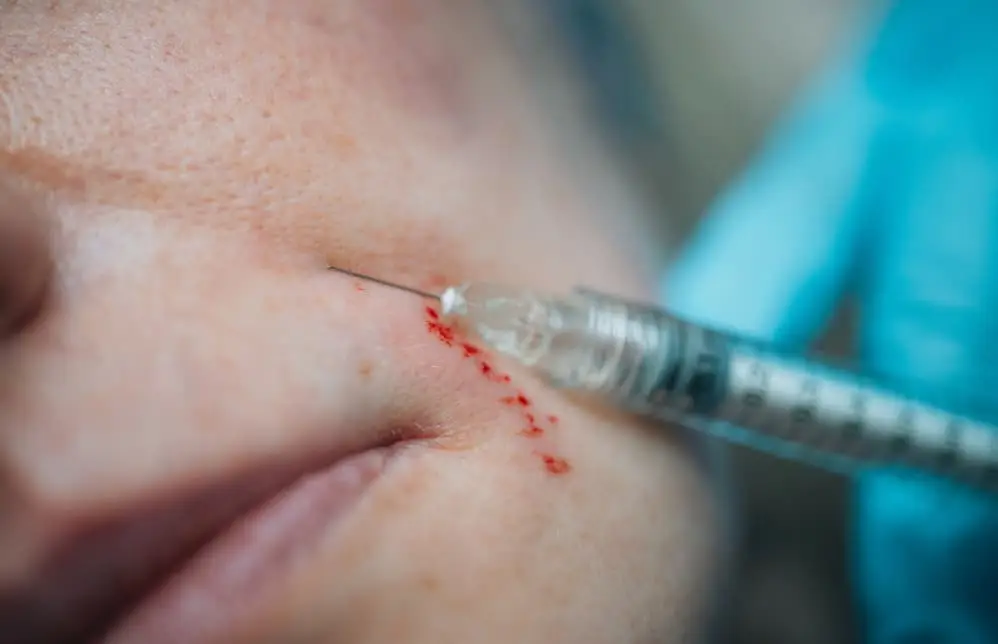 Injection around mouth