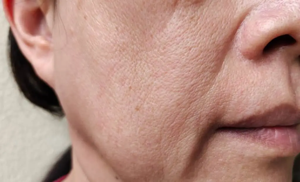 Lines around mouth