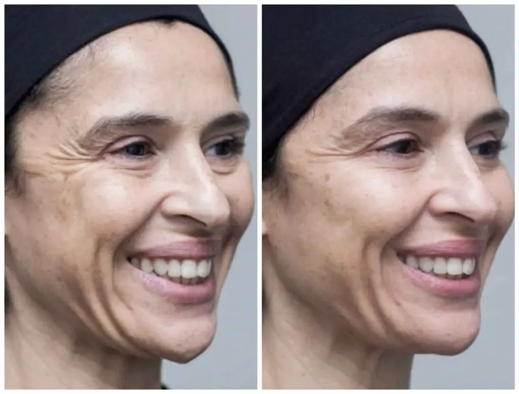 cheek fillers before and after