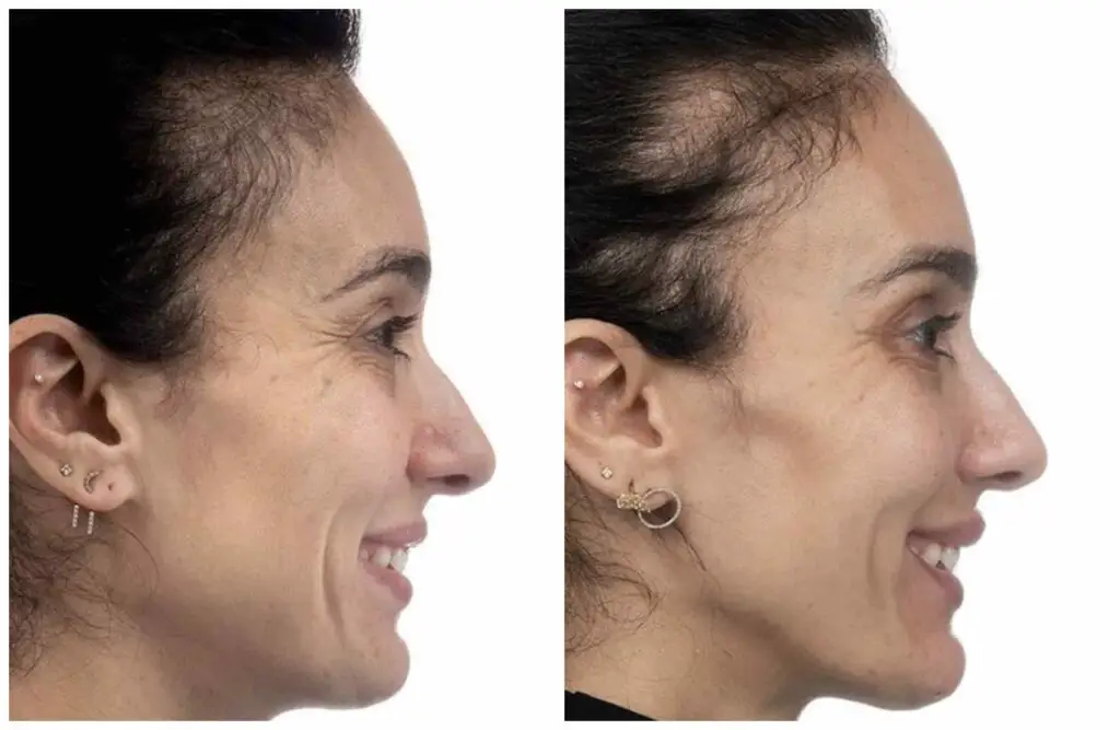 fillers before and after