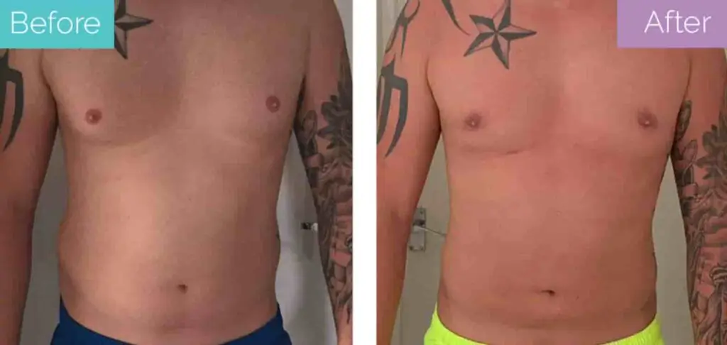 male liposuction