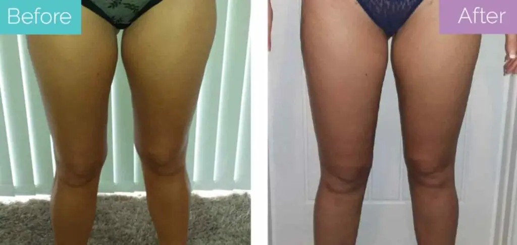 thigh liposuction