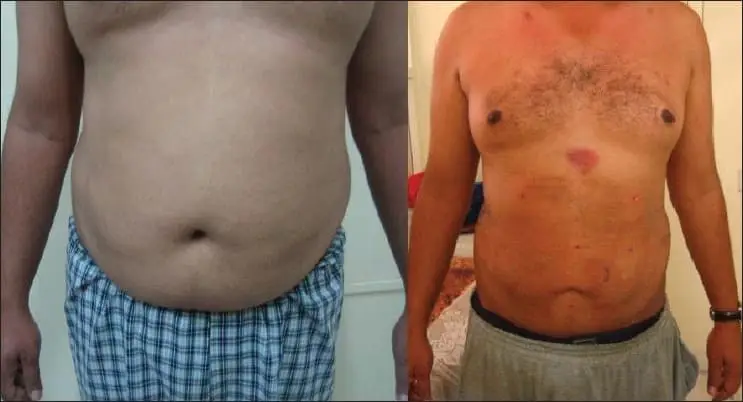 tumescent liposucton before and after