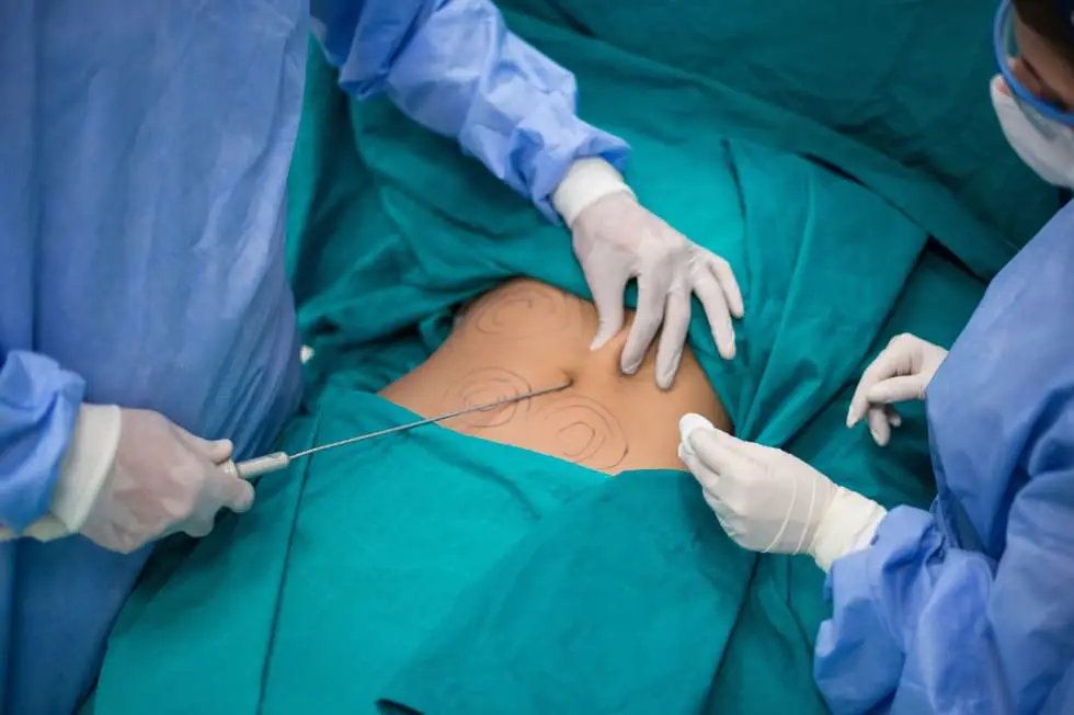 woman getting liposuction
