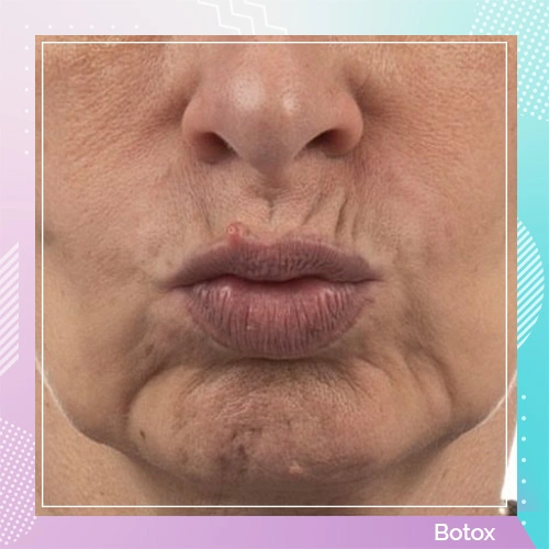 Dr Gizem Botox Patient After 2