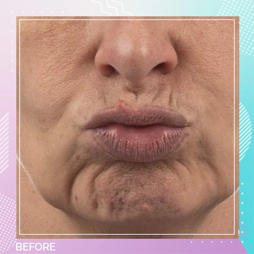 Dr Gizem Botox Patient Before 2