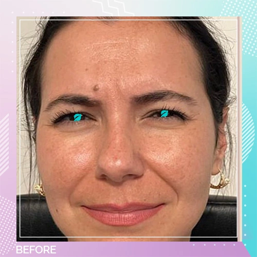 Dr Gizem Botox Patient Before