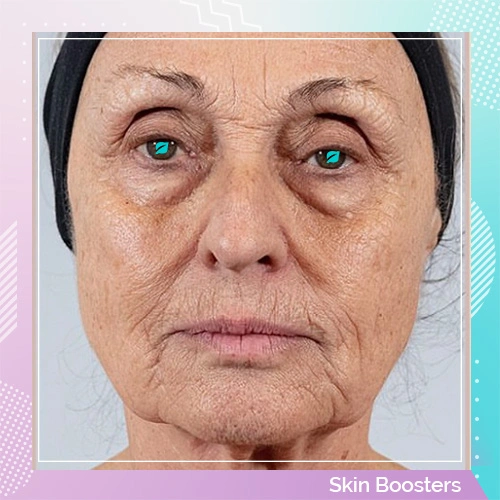Skin Booster patient 3 after