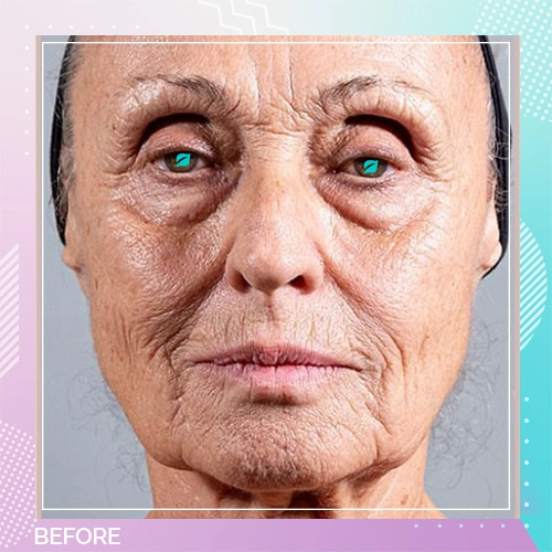 Skin Booster patient 3 before