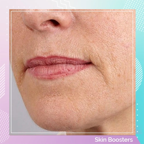 Skin Booster patient 4 after